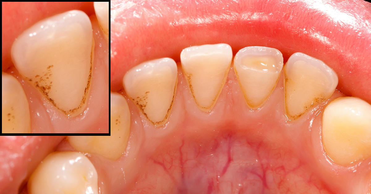 How to Prevent Cavities and Gum Disease