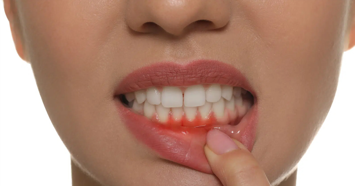 How to Prevent Cavities and Gum Disease