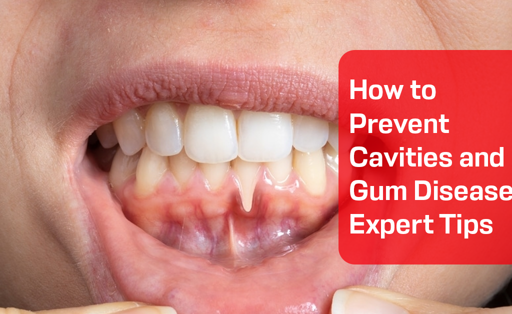 How to Prevent Cavities and Gum Disease