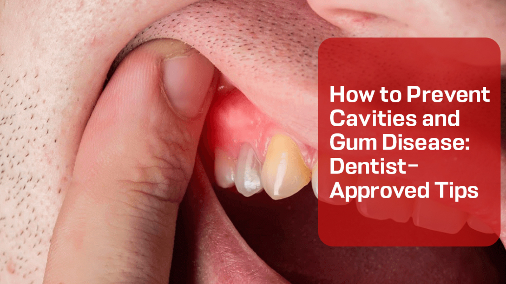 Prevent Cavities and Gum Disease