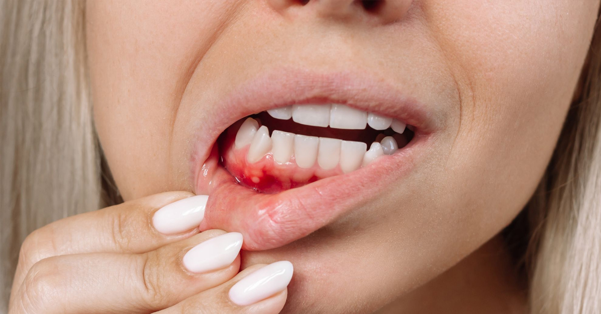 Prevent Cavities and Gum Disease