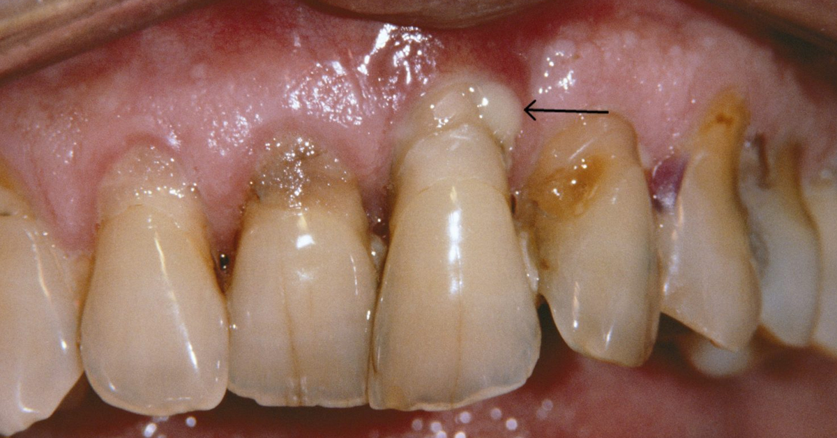 Prevent Cavities and Gum Disease